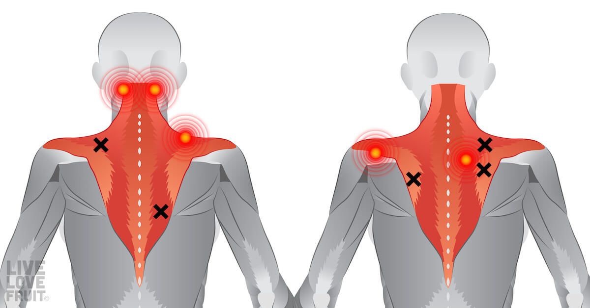 Intercostal spine rib